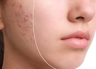 درمان جوش و جای جوش در اصفهان