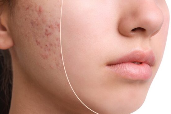 درمان جوش و جای جوش در اصفهان